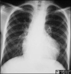 Tetralogy of Fallot